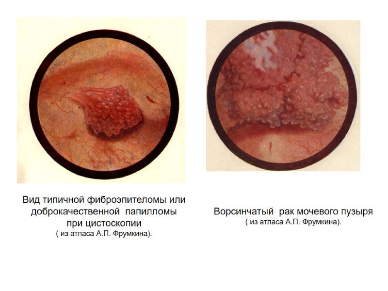 Вид типичной фиброэпителомы или доброкачественной  папилломы  при цистоскопии  ( из атласа